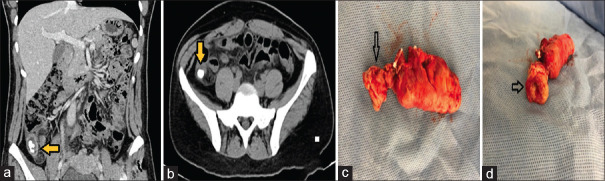 Appendiceal actinomycosis presenting as acute appendicitis: A diagnostic and therapeutic challenge.