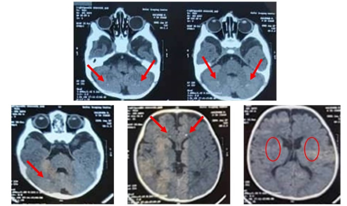 Homozygous mutation in <i>CSF1R</i> causes brain abnormalities, neurodegeneration, and dysosteosclerosis (BANDDOS).