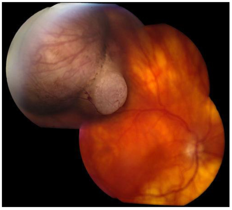 Choroidal Melanoma: A Mini Review.