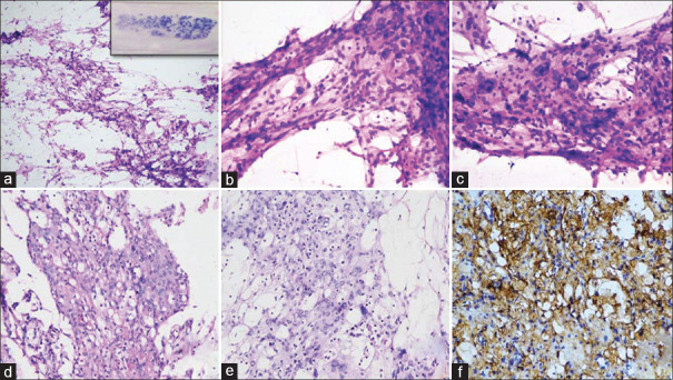 Microcystic Meningioma - A Diagnostic Dilemma During Intraoperative Squash Smear Study.