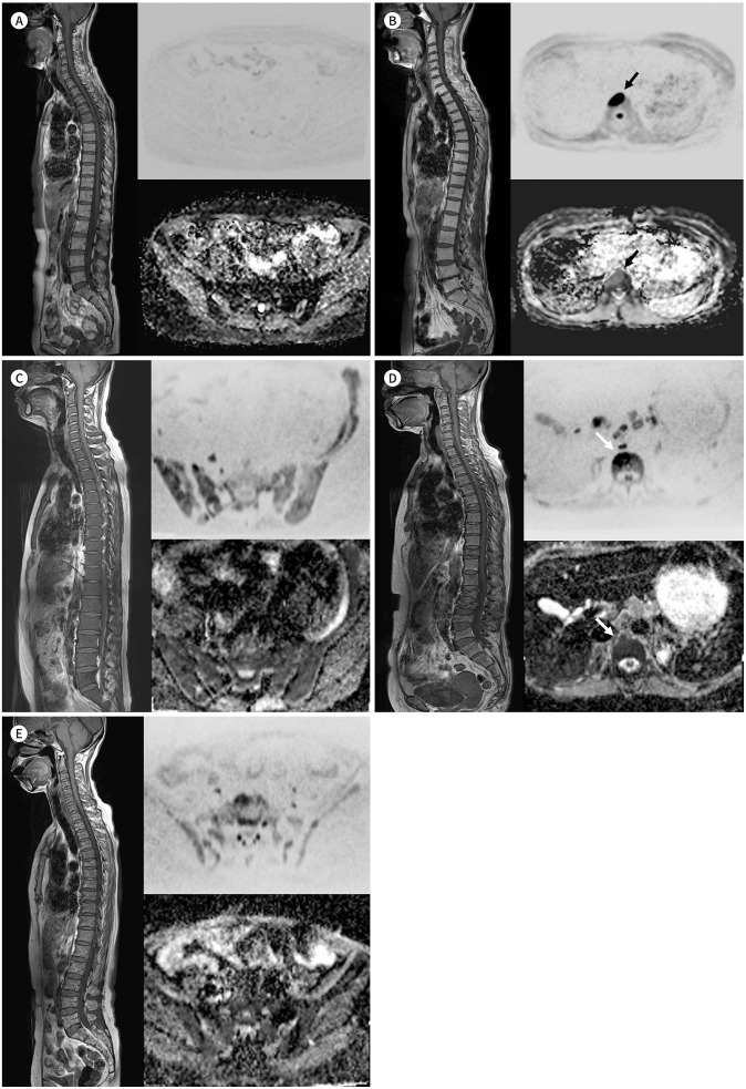 [Clinical Application and Limitations of Myeloma Response Assessment and Diagnosis System (MY-RADS)].