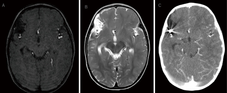 Ruptured Middle Cerebral Artery Aneurysm in an Infant: Case Report and Literature Review.