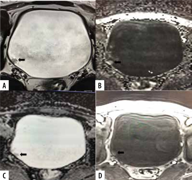 Diagnostic performance of multiparametric MRI based Vesical Imaging-Reporting and Data System (VI-RADS) scoring in discriminating between non-muscle invasive and muscle invasive bladder cancer.