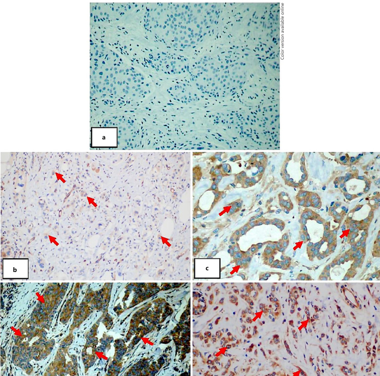 Nuclear Factor-κB Clinical Significance in Breast Cancer: An Immunohistochemical Study.