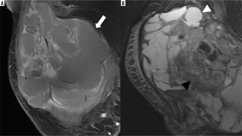 Primary synovial sarcoma on MRI - a case series and review of the literature.