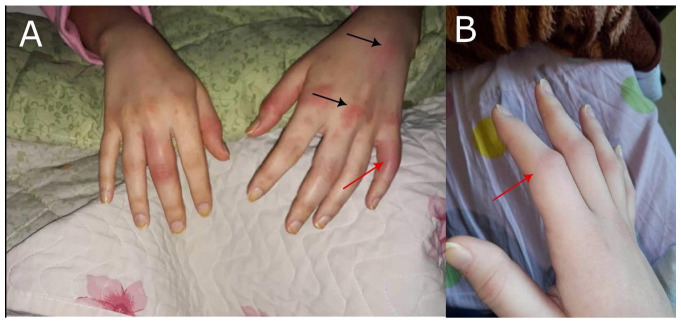 An Unforeseen Outcome of COVID-19: The Triggering of Adult-Onset Still's Disease.