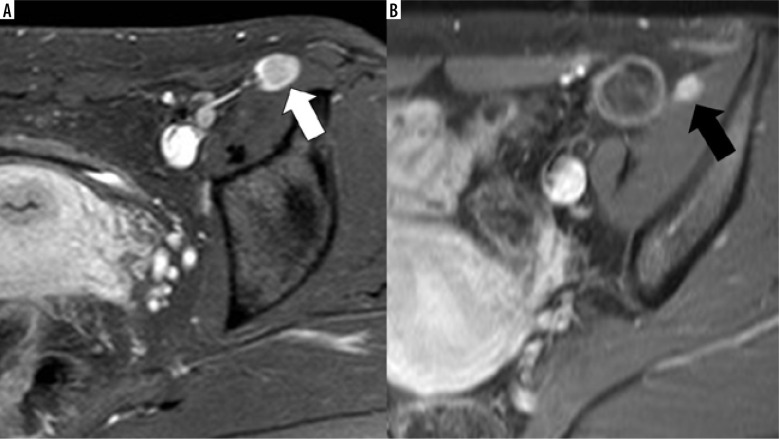 Primary synovial sarcoma on MRI - a case series and review of the literature.