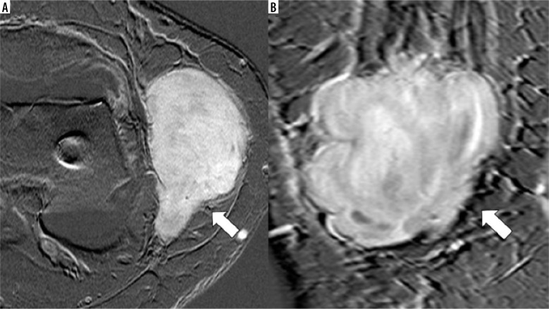 Primary synovial sarcoma on MRI - a case series and review of the literature.