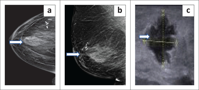 Outcomes of breast conserving therapy: Recurrence, imaging findings and histological correlation.