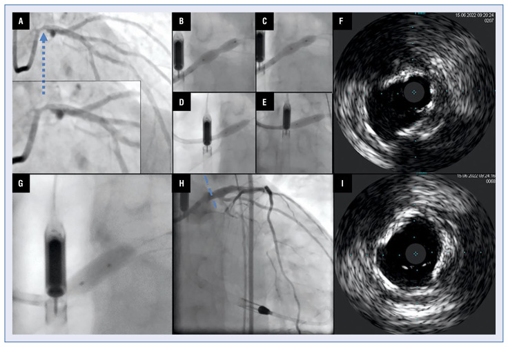 Impella-assisted intracoronary lithotripsy of heavily calcified left main lesion in a patient with severely impaired ejection fraction and the last remaining patent vessel.