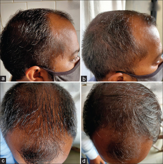 Efficacy of Low-Level Laser Therapy in Androgenetic Alopecia - A Randomized Controlled Trial.