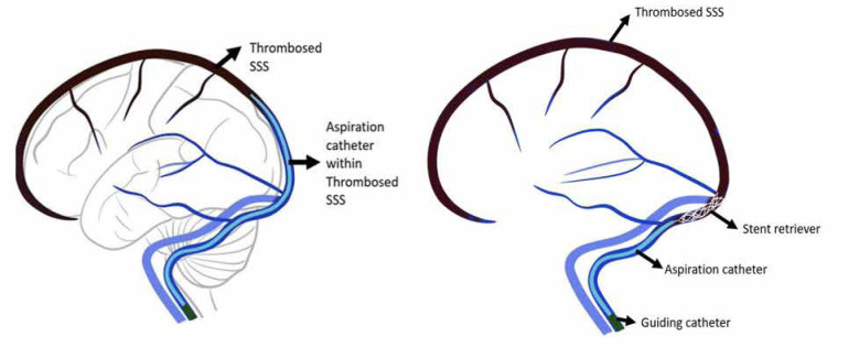 Endovascular management of cerebral venous thrombosis: a tertiary-centre experience.