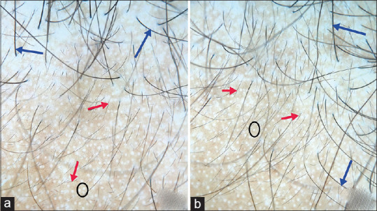 Efficacy of Low-Level Laser Therapy in Androgenetic Alopecia - A Randomized Controlled Trial.