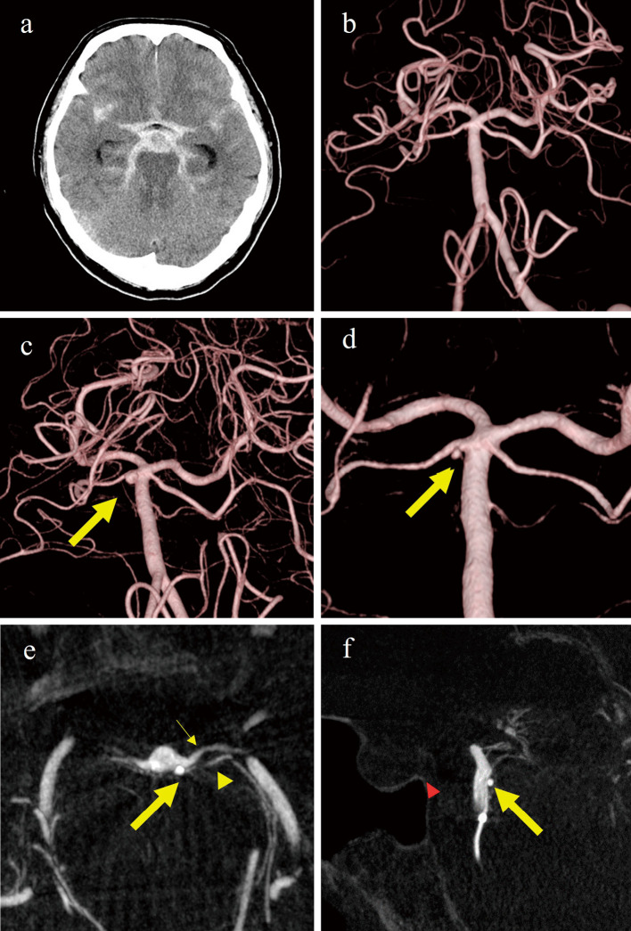 Ruptured Basilar Artery Perforator Aneurysm Definitely Diagnosed with Intraoperative Microsurgical Findings: Case Report and Literature Review.