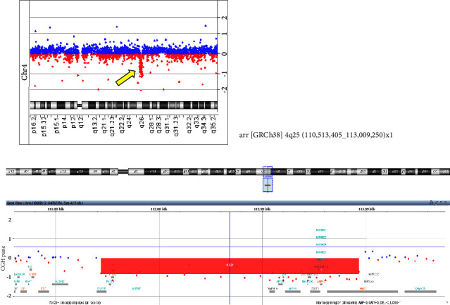 4q25 Microdeletion with Axenfeld-Rieger Syndrome and Developmental Delay.