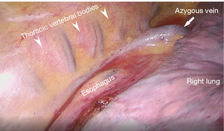 Anatomy of mediastinal veins and nerves.