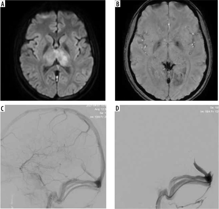 Endovascular management of cerebral venous thrombosis: a tertiary-centre experience.