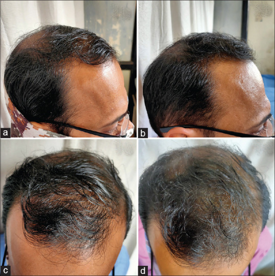 Efficacy of Low-Level Laser Therapy in Androgenetic Alopecia - A Randomized Controlled Trial.