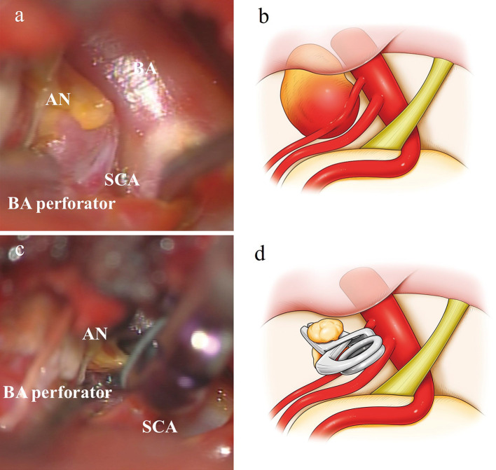 Ruptured Basilar Artery Perforator Aneurysm Definitely Diagnosed with Intraoperative Microsurgical Findings: Case Report and Literature Review.