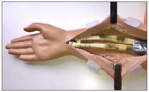 DEVELOPMENT OF ORTHOPEDIC SIMULATOR TO PRACTICE CLOSED REDUCTION OF PEDIATRIC FRACTURES OF THE MIDDLE THIRD OF FOREARM.