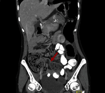 Pelvic Organ Prolapse in Ehlers-Danlos Syndrome.