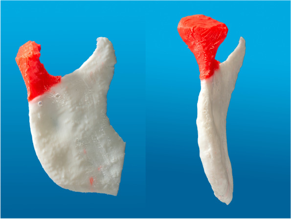 Methodology: workflow for virtual reposition of mandibular condyle fractures.