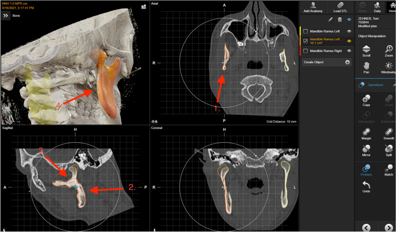 Methodology: workflow for virtual reposition of mandibular condyle fractures.