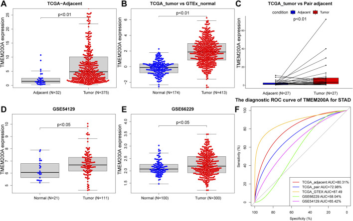 High expression of TMEM200A is associated with a poor prognosis and immune infiltration in gastric cancer.