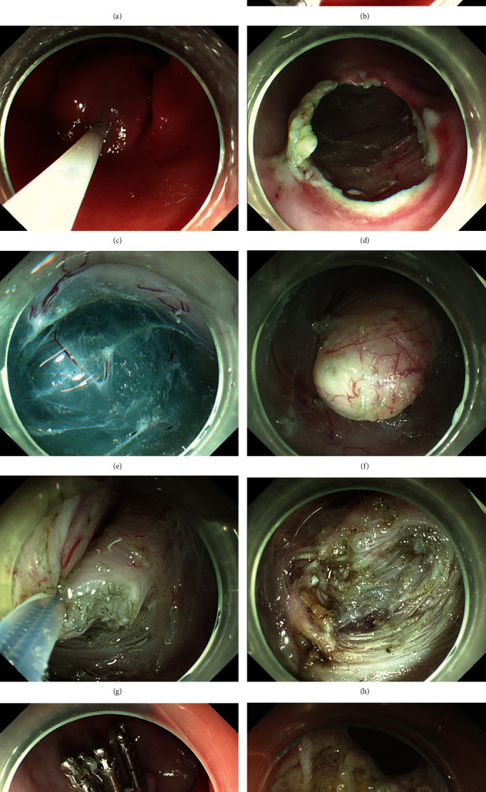 Comparison between Submucosal Tunneling Endoscopic Resection and Endoscopic Submucosal Dissection for Prepyloric Submucosal Tumors: A Case-Matched Controlled Study.