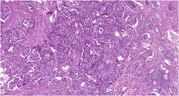 Case report: Vulval sebaceous carcinoma: a report of two cases and literature review focus on treatment and survival.