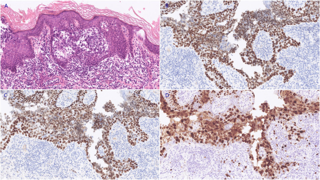 Case report: Vulval sebaceous carcinoma: a report of two cases and literature review focus on treatment and survival.