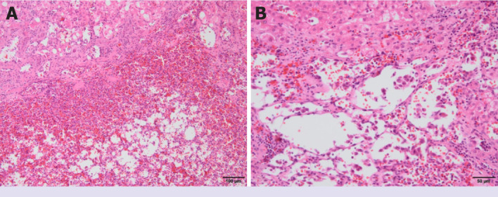 A rare benign tumor of the liver mimicking angiosarcoma: Anastomosing hemangioma.