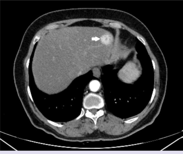 A rare benign tumor of the liver mimicking angiosarcoma: Anastomosing hemangioma.