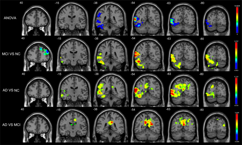 Disrupted Balance of Gray Matter Volume and Directed Functional Connectivity in Mild Cognitive Impairment and Alzheimer's Disease.