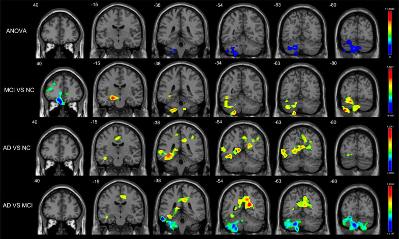 Disrupted Balance of Gray Matter Volume and Directed Functional Connectivity in Mild Cognitive Impairment and Alzheimer's Disease.