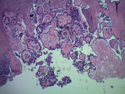 Bilateral Ovarian Serous Borderline Tumor with Non-Invasive Endometrial Implants.