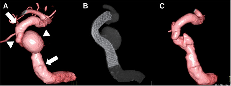 Treatment Outcomes of 94 Cases of Pipeline Embolization Device in a Single Center: Predictive Factors of Incomplete Aneurysm Occlusion.