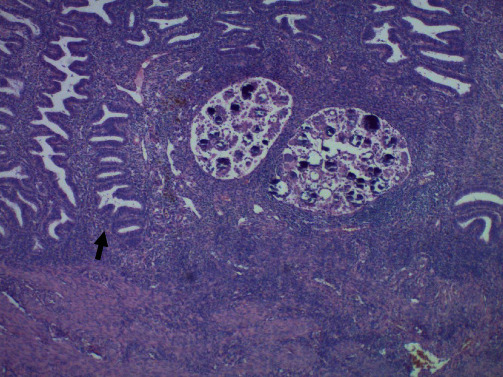 Bilateral Ovarian Serous Borderline Tumor with Non-Invasive Endometrial Implants.