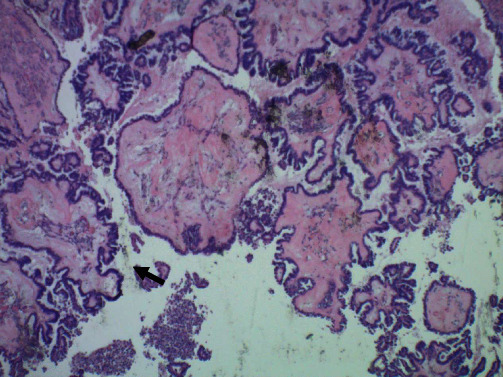 Bilateral Ovarian Serous Borderline Tumor with Non-Invasive Endometrial Implants.