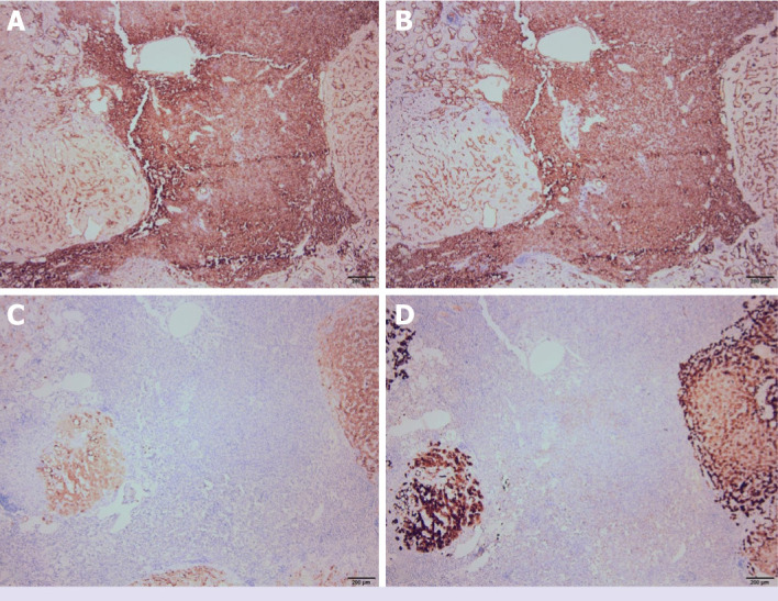 A rare benign tumor of the liver mimicking angiosarcoma: Anastomosing hemangioma.