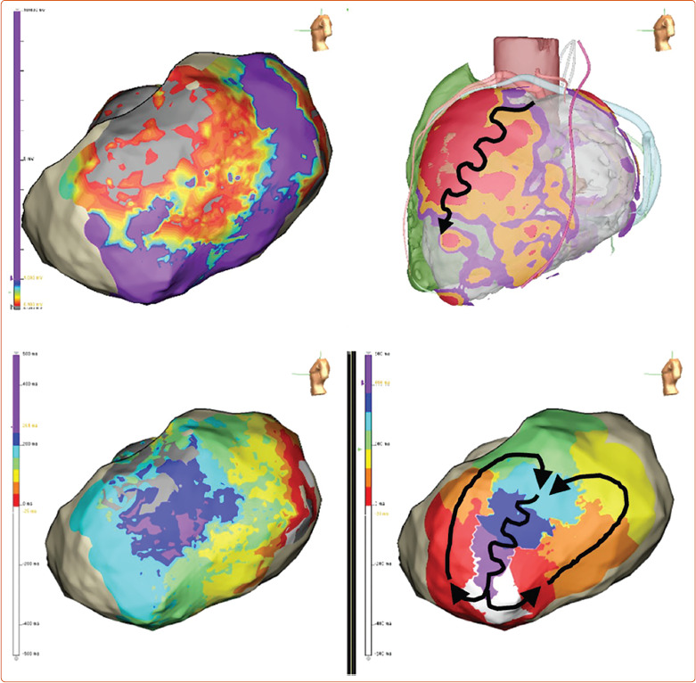 Solving the Reach Problem: A Review of Present and Future Approaches for Addressing Ventricular Arrhythmias Arising from Deep Substrate.