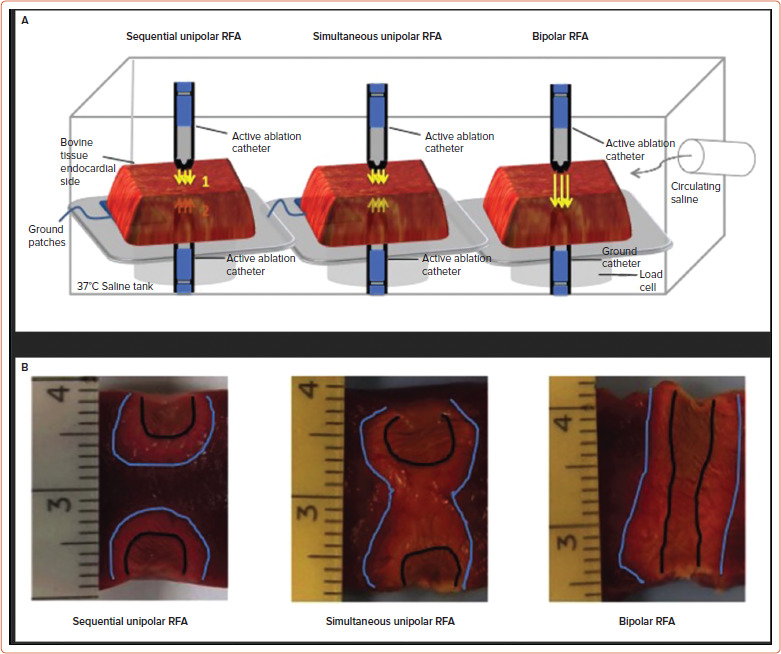 Solving the Reach Problem: A Review of Present and Future Approaches for Addressing Ventricular Arrhythmias Arising from Deep Substrate.