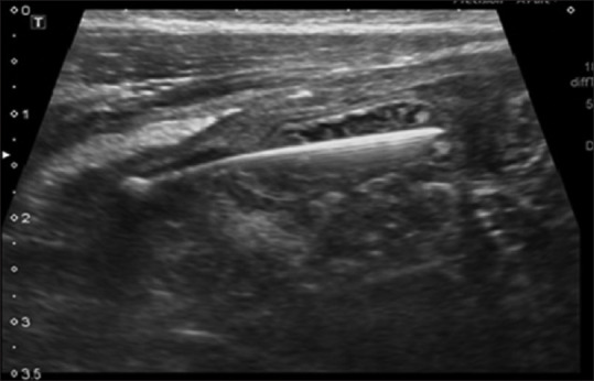 A Pediatric Right Lower Quadrant Pain Case.