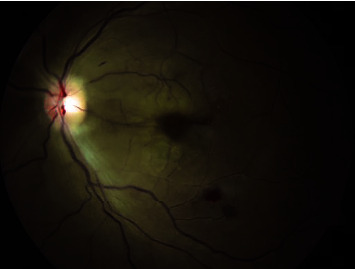 Central Retinal Artery Occlusion with Concomitant Intracranial Hemorrhage Secondary to <i>Streptococcus Gordonii</i> Endocarditis.