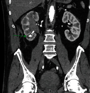 Renal Pseudoaneurysm with Associated Arteriovenous Fistula as a Cause of Delayed Bleeding after Percutaneous Nephrolithotomy: A Case Report and Current Literature Review.