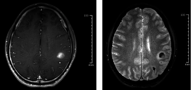 Central Retinal Artery Occlusion with Concomitant Intracranial Hemorrhage Secondary to <i>Streptococcus Gordonii</i> Endocarditis.