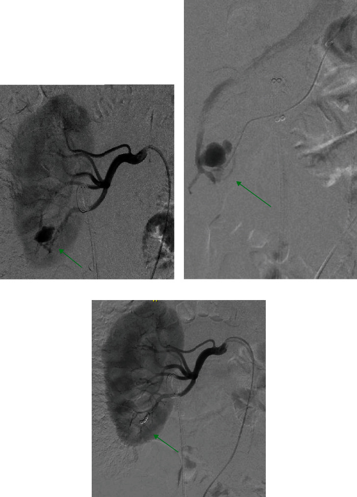 Renal Pseudoaneurysm with Associated Arteriovenous Fistula as a Cause of Delayed Bleeding after Percutaneous Nephrolithotomy: A Case Report and Current Literature Review.