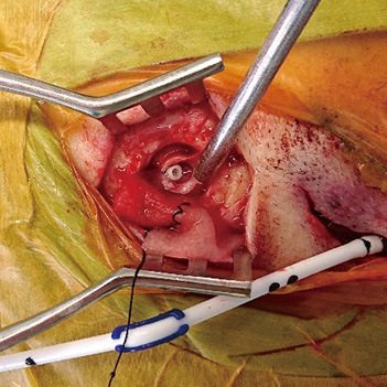 Ventriculoperitoneal Shunt Failure 3-year after Shunt Surgery Caused by Migration of Detached Ventricular Catheter into the Cranium: A Case Study of Idiopathic Normal-pressure Hydrocephalus.