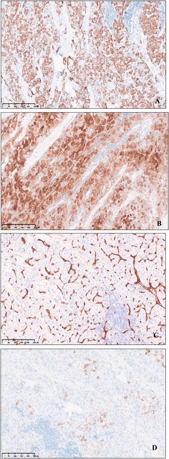 Indolent T-lymphoblastic proliferation with fibrolamellar hepatocellular carcinoma developed after colorectal adenocarcinoma: a case report.