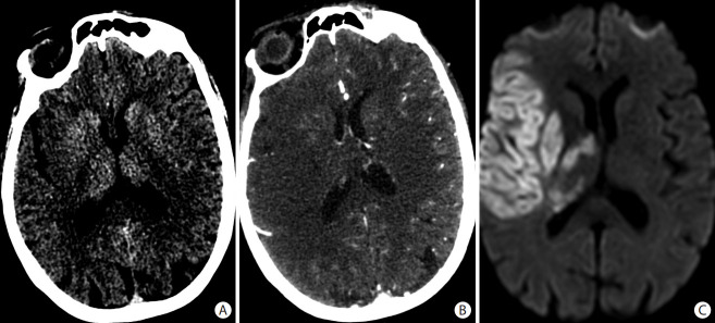 Neuroimaging of Acute Ischemic Stroke: Multimodal Imaging Approach for Acute Endovascular Therapy.